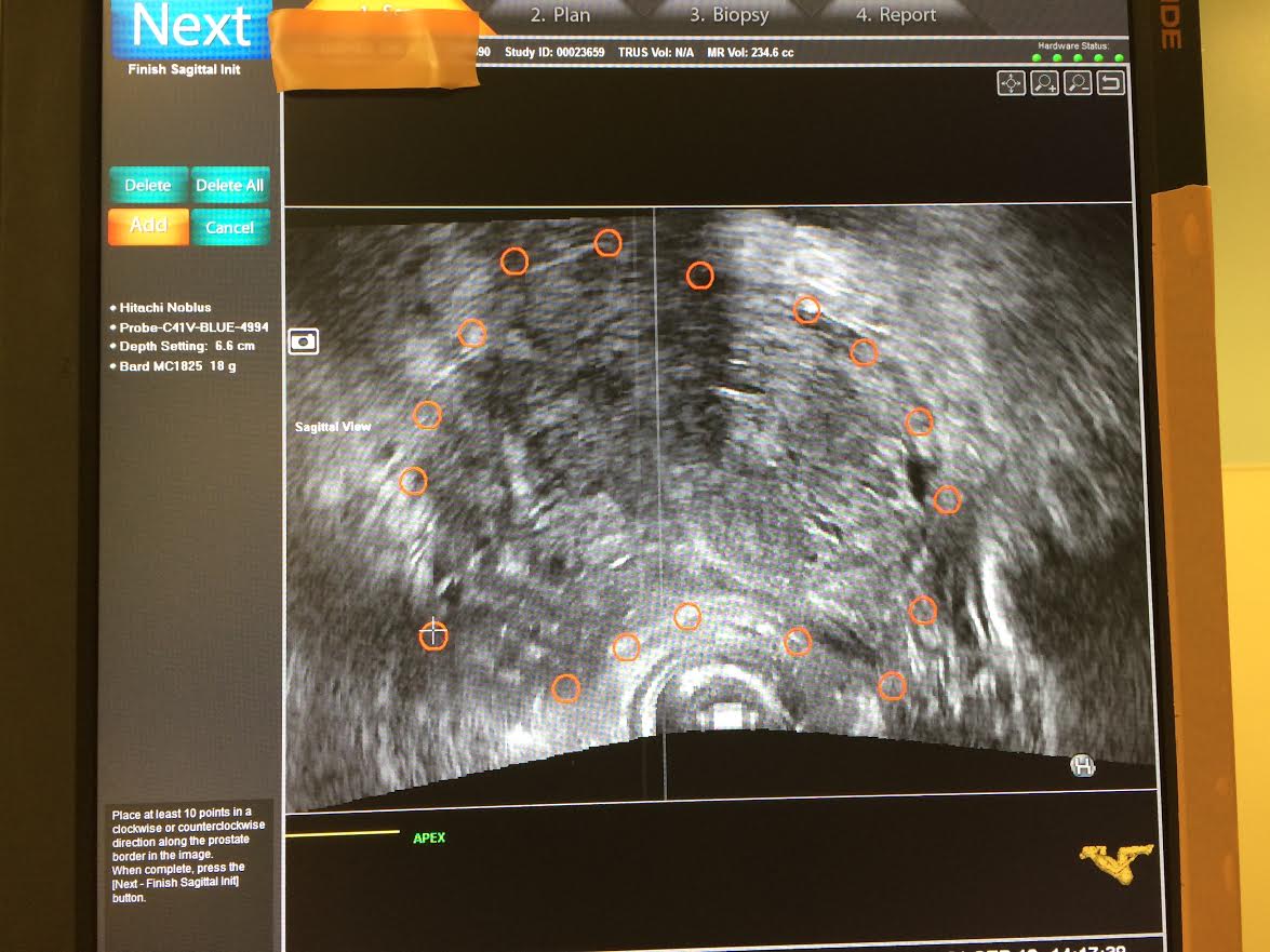 US image captured, outlined & refine of MRI Guided Fusion Prostate Biopsy