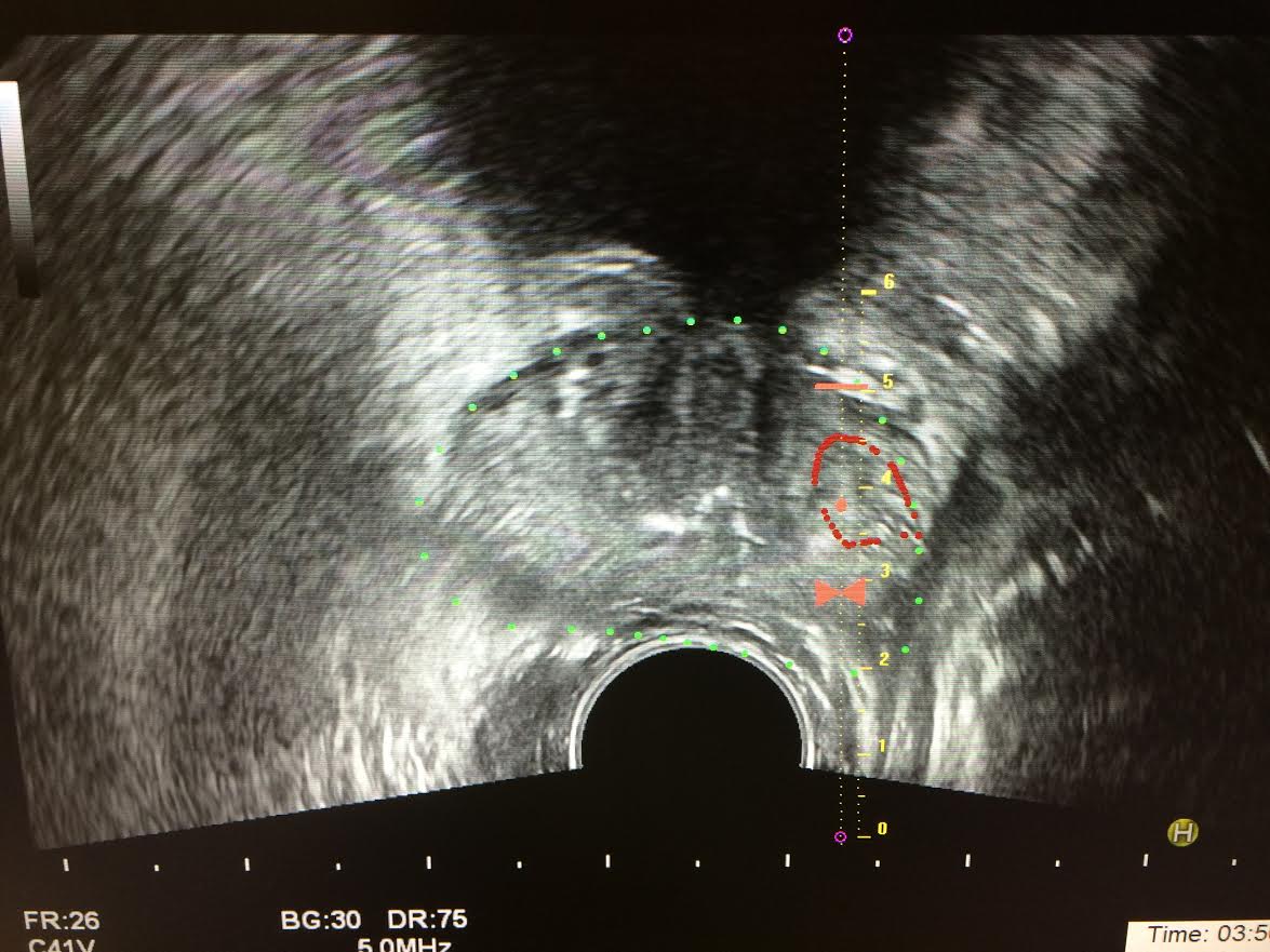 MRI Guided Fusion Prostate Biopsy MRI mapped preop with lesion highlighted in red