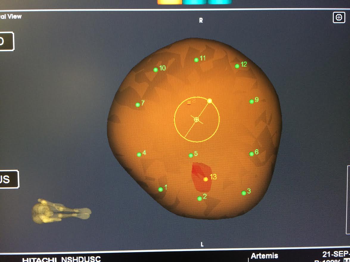 MRI Guided Fusion Prostate Biopsy computer rendering