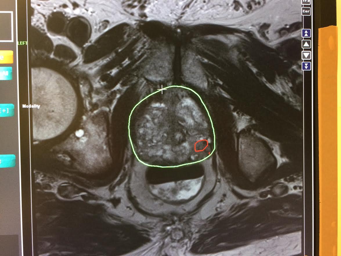 MRI Guided Fusion Prostate Biopsy live US image