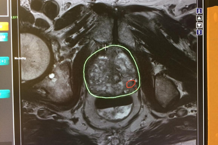 1 cm lesion on prostate