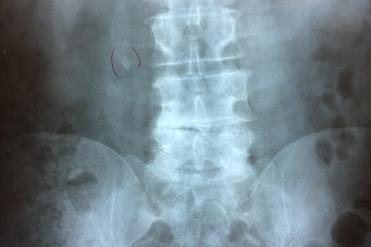 An example of why Extracorporeal Shock Wave Lithotripsy is needed.