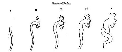 Grades_of_reflux_495x210