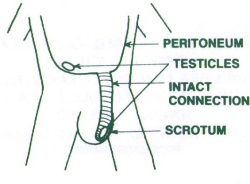 Hydrocele