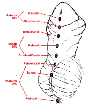 Hypospadias