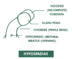 Hypospadias