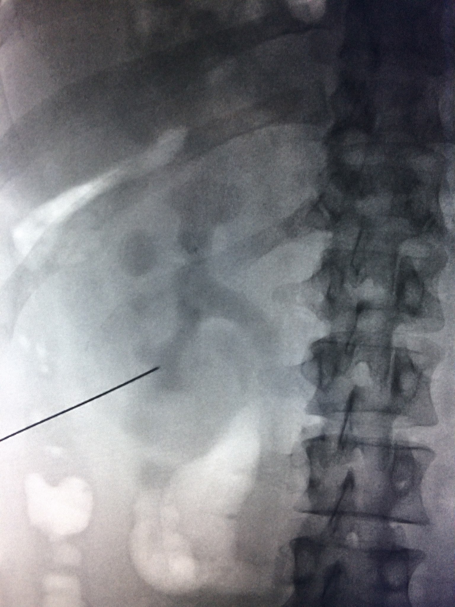 Xray of Percutaneous Nephrolithotomy, Needle and access placement