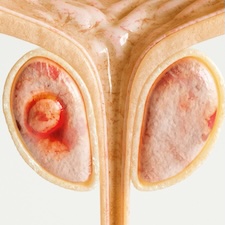Illustration of prostate cancer