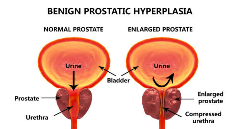 benign prostatic hyperplasia (bph) is characterized by