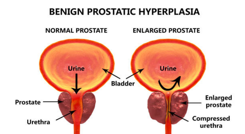 Prostatitis hemoglobin a vizeletben Mágnes a prosztatitis megvásárlásához