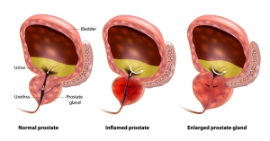 Diagram 3d rendering of progressive Benign Prostatic Hyperplasia with urine buildup