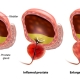 Diagram 3d rendering of progressive Benign Prostatic Hyperplasia with urine buildup