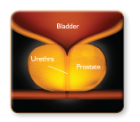 Urolift Prostate photo