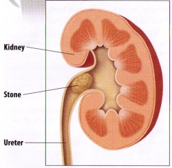 Urolithiasis