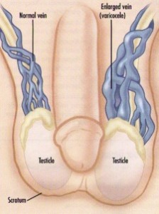 Varicocele