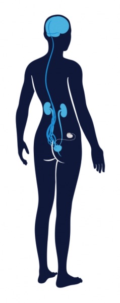 illustration of Interstim device in bladder