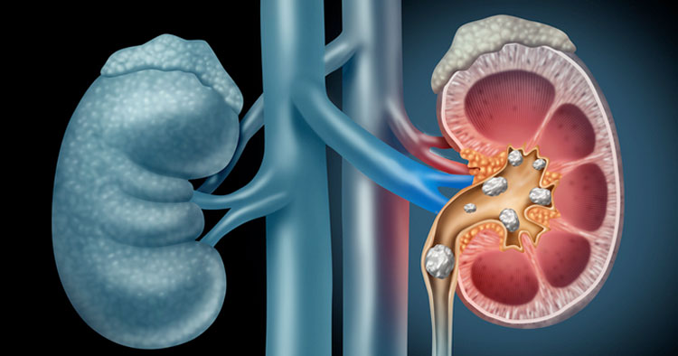 Close up of kidneys, showing Painful Kidney Stones