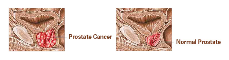 Diagram of prostate cancer vs a normal prostate