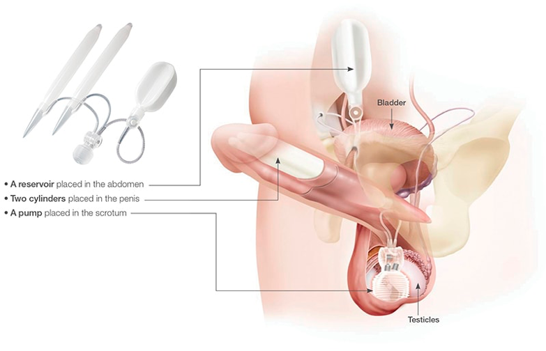 List of 10+ penile implant cost with insurance 1 Sign Up for Our Newsletter