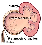 ureteropelvic_junction